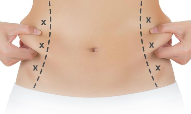 LIPOSUCCIÓN